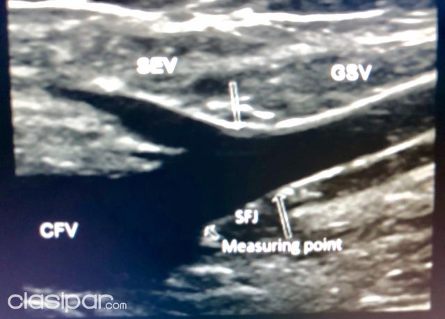 VARICES ECOGRAFIA DOPPLER DE MIEMBROS INFERIORES PIE DIABETICO | Clasipar Salud y belleza - VARICES ECOGRAFIA DOPPLER DE MIEMBROS INFERIORES PIE DIABETICO
