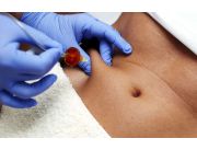 TRATAMIENTO CARBOXITERAPIA CORPORAL | Clasipar Belleza / Estética - TRATAMIENTO CARBOXITERAPIA CORPORAL